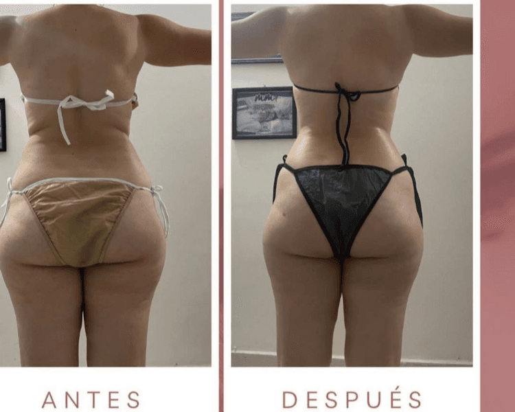 PAQUETE REDUCTOR ABDOMEN 20 SESIONES