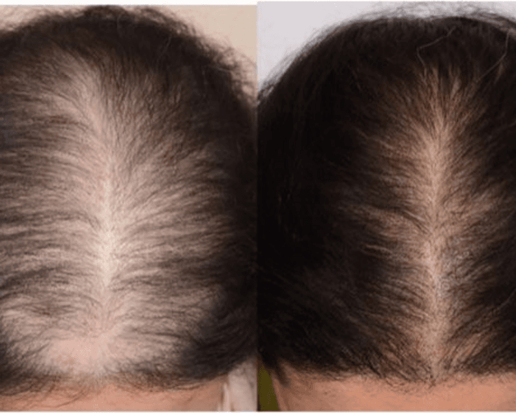 PRP Capilar o facial (Plasma Rico en Plaquetas), 1 sesión