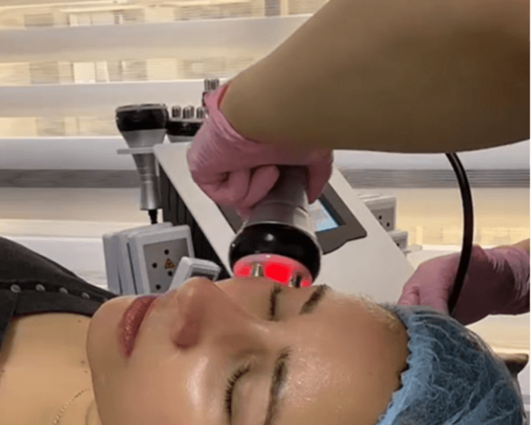 Tratamiento Lifting facial sin cirugía (3 sesiones)