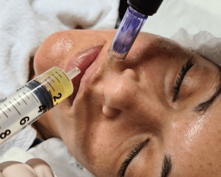 PRP (Plasma Rico en Plaquetas) facial + capilar 1 sesión