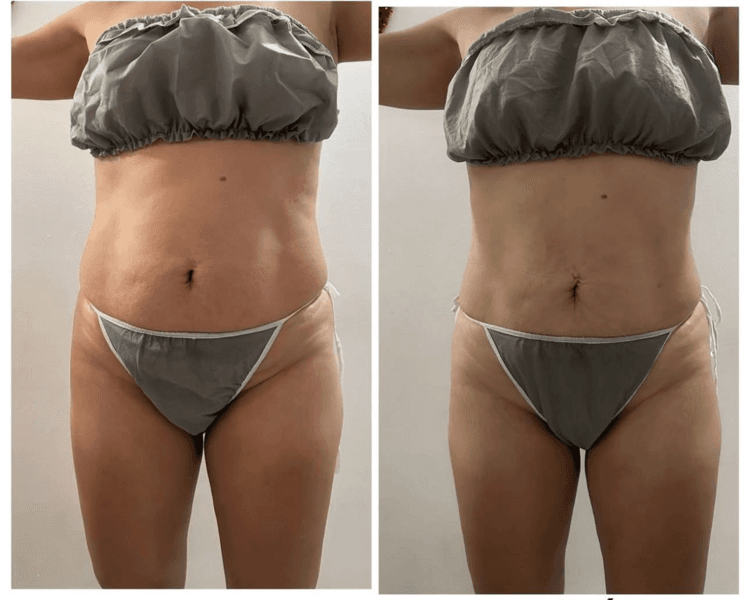PAQUETE REDUCTOR ABDOMEN 10 SESIONES