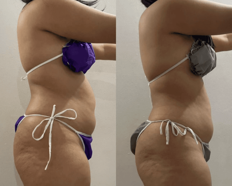 PAQUETE REDUCTOR EN ABDOMEN 15 SESIONES