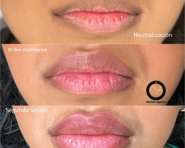 Neutralización de Labios