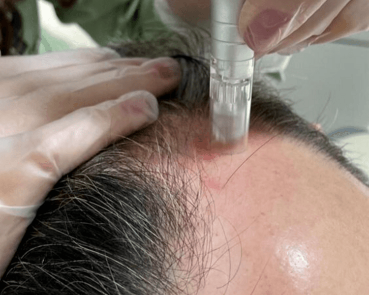 Terapia capilar anticaída y fortalecimiento