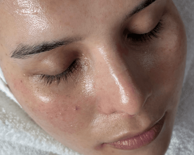 Sesion de Radiofrecuencia fraccionada