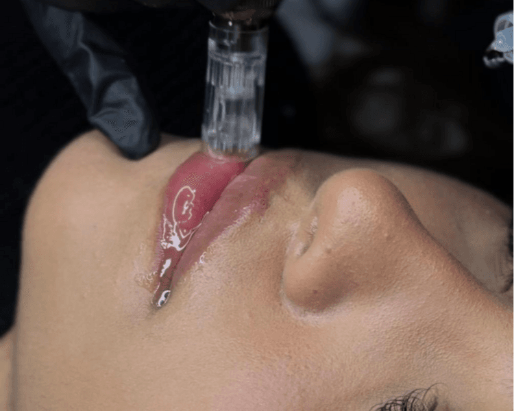 HidraLips paquete x3 sesiones