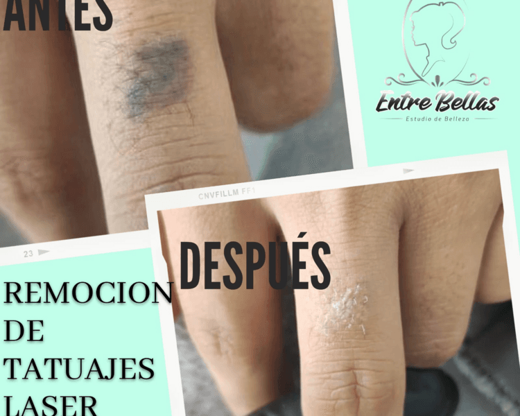 ELIMINACION DE TATAUAJES LASER
