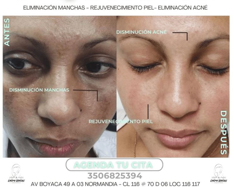 DESPIGMENTACION MANCHAS PUNTUAL LASER