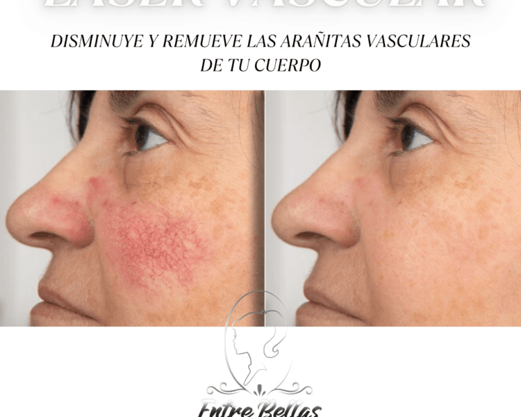 ARAÑITAS VASCUALARES