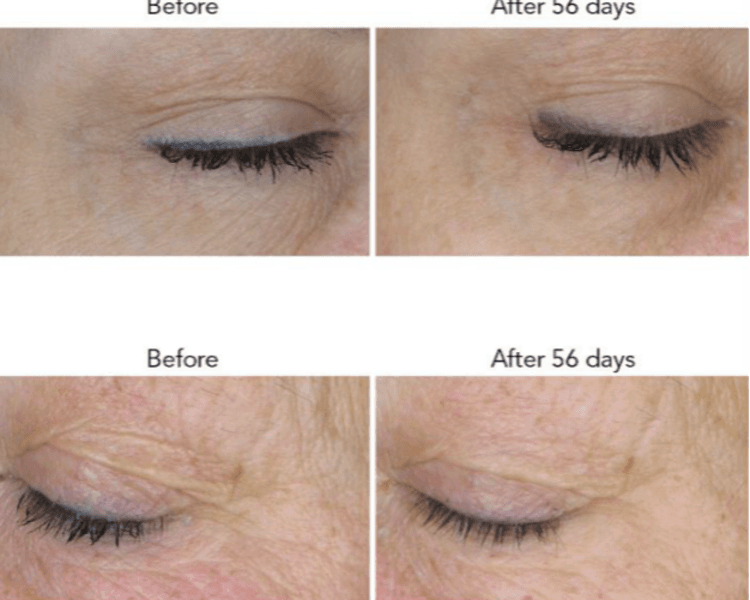 Exosomas Vegetales Rejuvenecimiento facial pack 4 sesiones