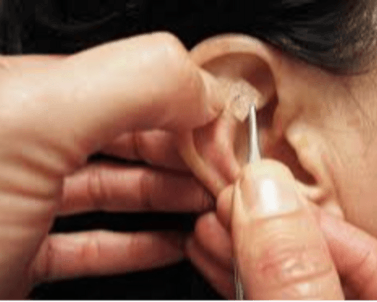 SEGUIMIENTO Acupuntura