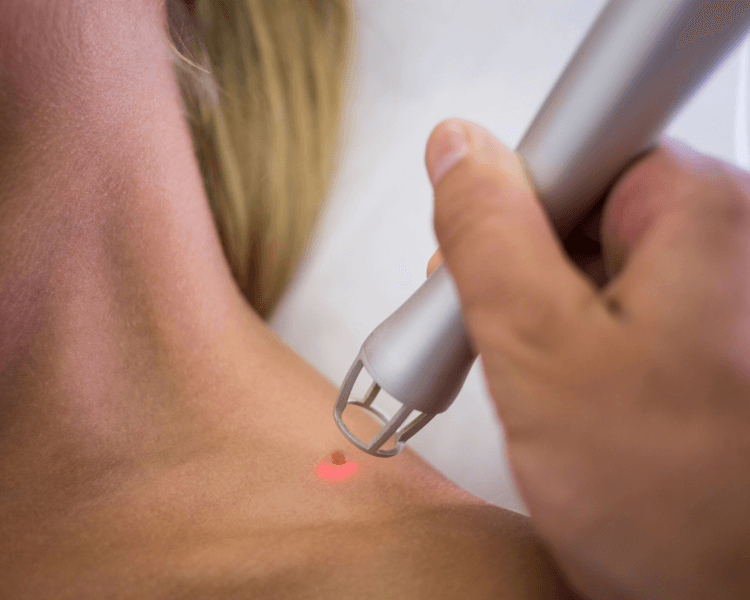 CAUTERIZACIÓN DE LUNARES (REQUIERE VALORACIÓN PRIMERO)