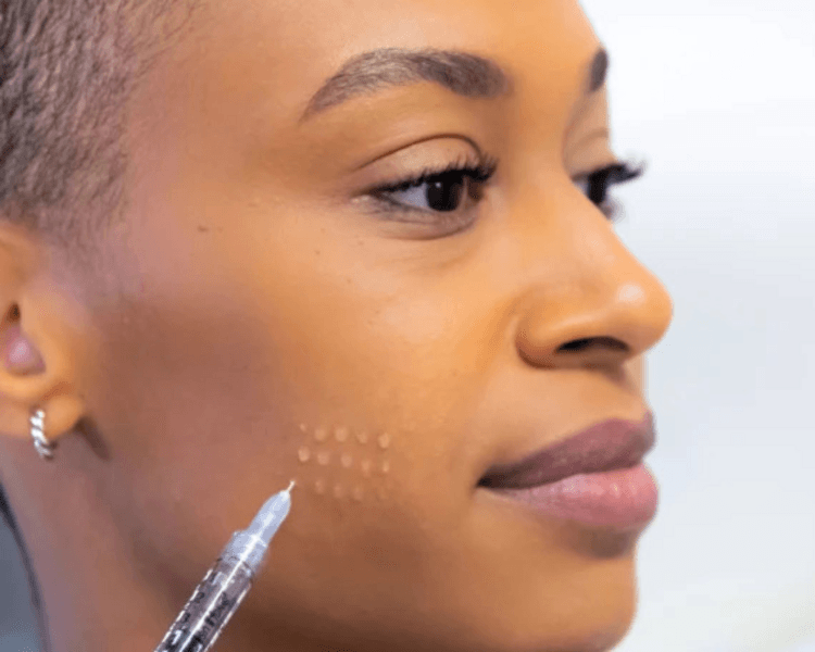 SKIN BOOSTER X 5 SESIONES