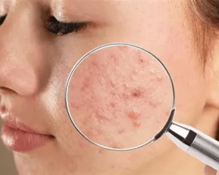 Limpieza Facial Adolescente