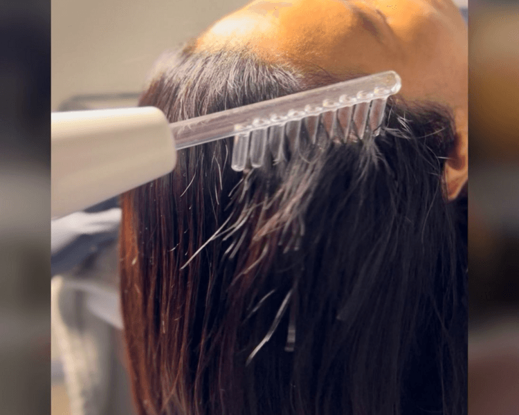 Tratamiento Capilar con Alta Frecuencia