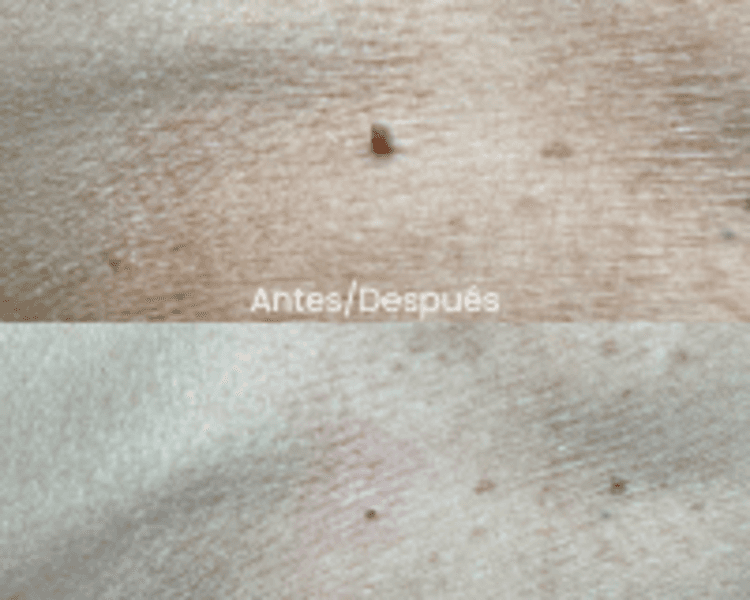 Eliminación de Acrocordones