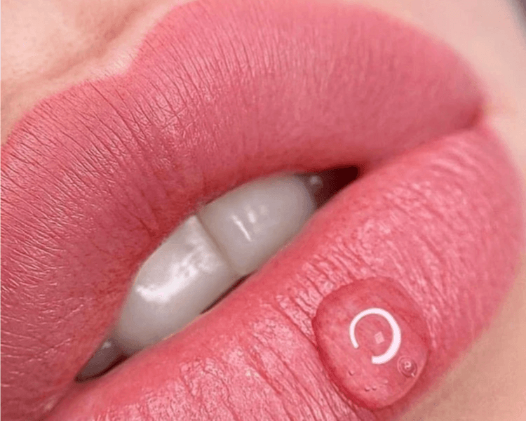 Retoque anual Soft Lips (1 sesión)