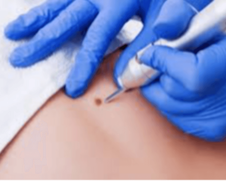 Fibroblast Acrocordones