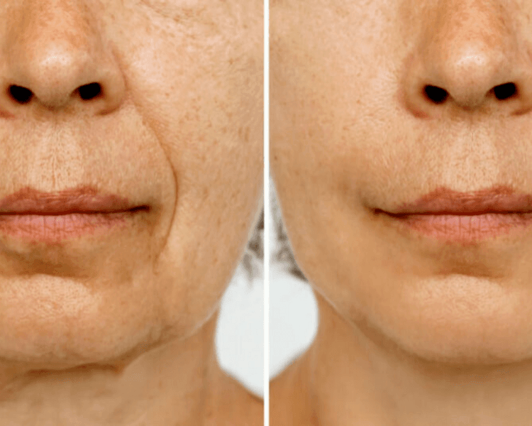 Ácido Hialurónico: Surcos Nasogenianos