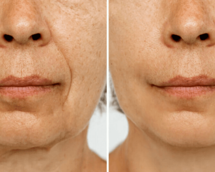 Ácido Hialurónico: Surcos Nasogenianos