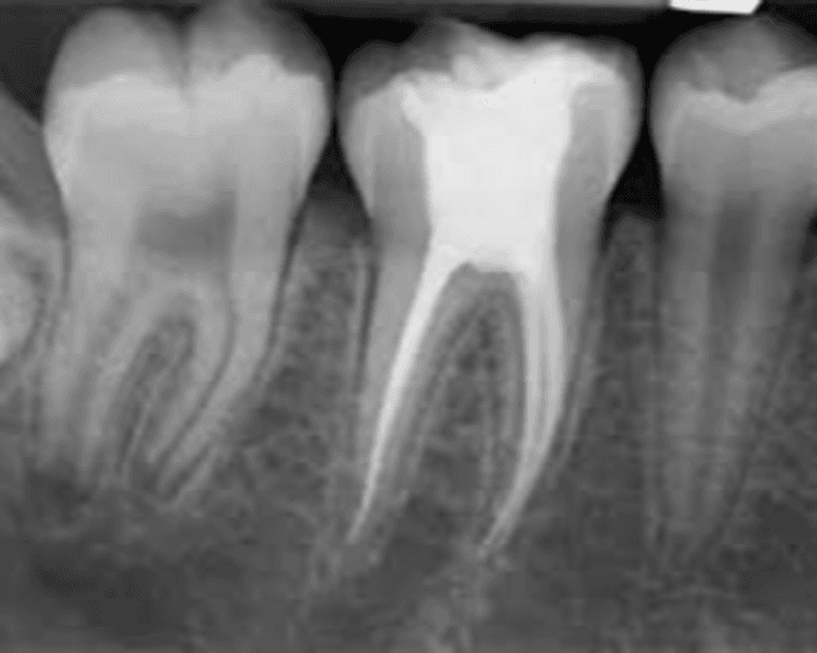 Endodoncia