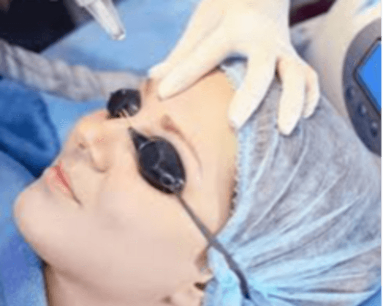 Despigmentacion Laser 3 Sesiones