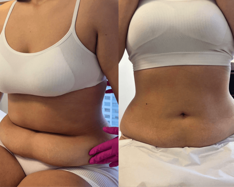 Criolipolisis Plana (todo abdomen) + 3 ems