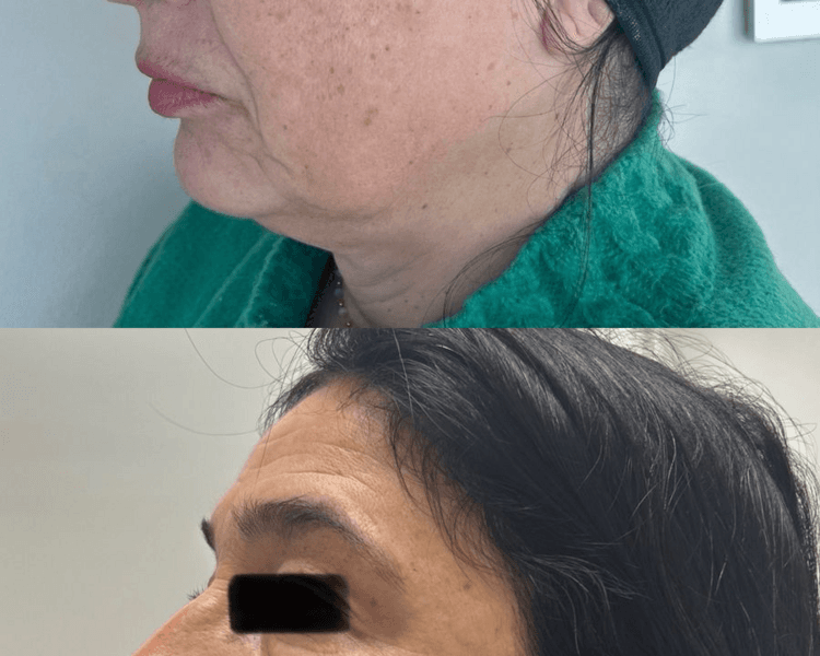 BIOESTIMULADOR SCULPTRA