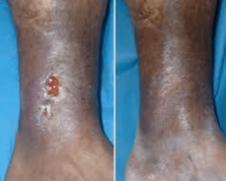 Curación Avanzada de Heridas (Pie Diabético- Ulceras Venosas y/o Arteriales)