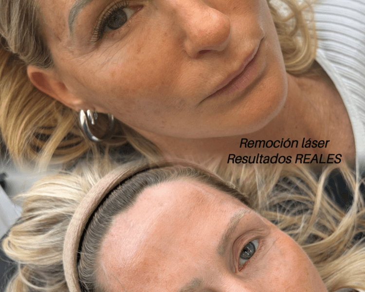 Remoción micropigmentacion CEJAS
