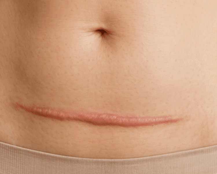 INFILTRACION DE QUELOIDES Y DE FIBROSIS