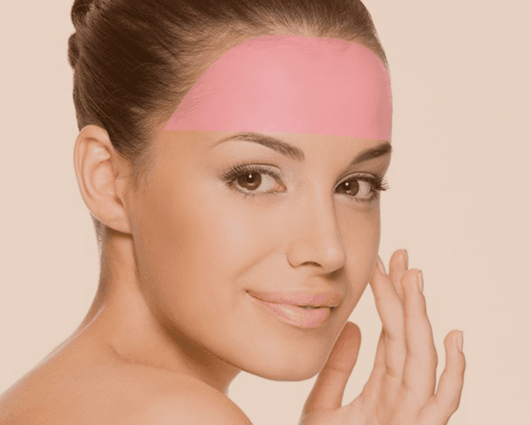 Depilación láser frente