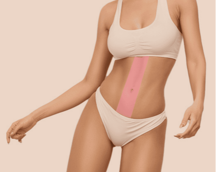 Depilación láser línea alba