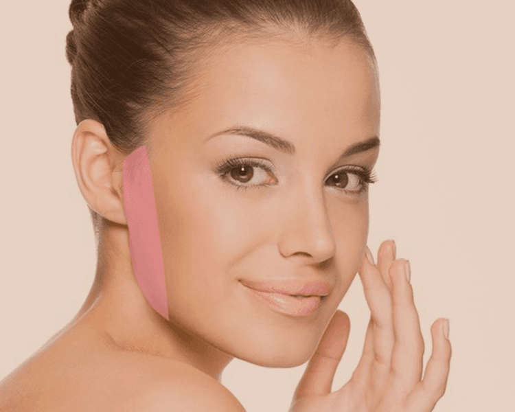 Depilación láser patillas