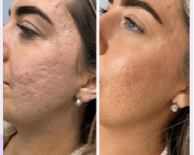 Polinucleotidos Plenhyage XL Stronge 2 ml