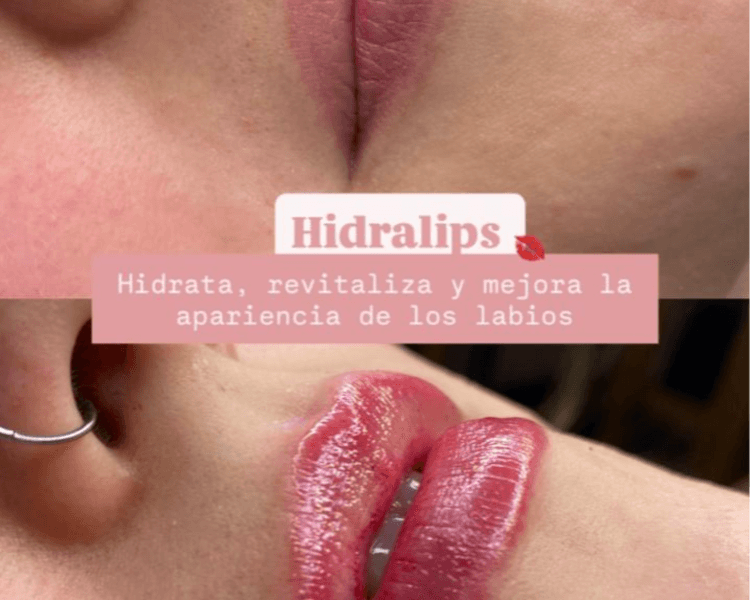 Hidralips