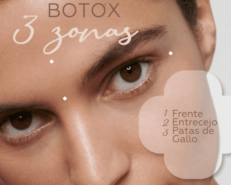 Botox Tercio Superior ( Frontal, entrecejo y patas de gallo )