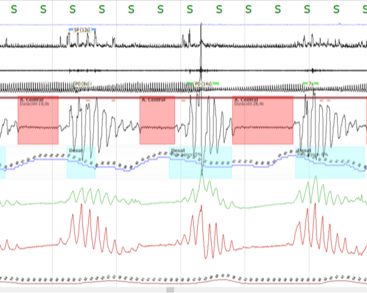 TITULACIÓN CON SERVOVENTILADOR