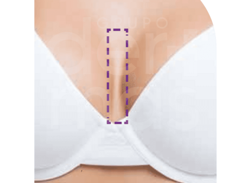 Depilación Entrepecho