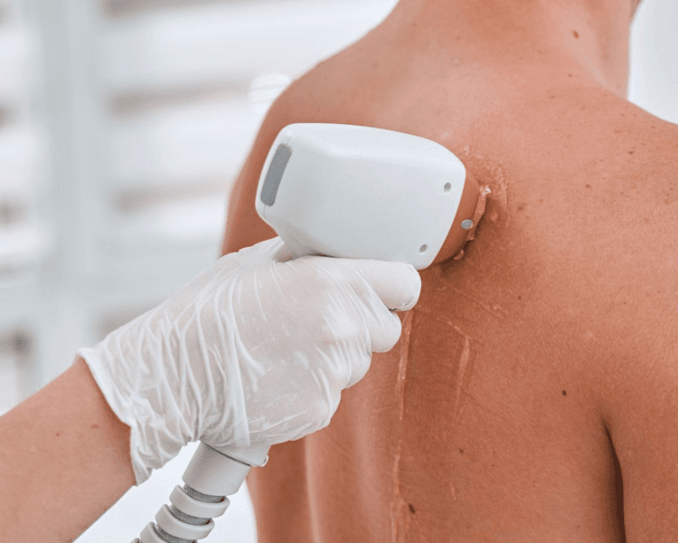 Depilación Láser Full Body. Bozo, axilas, piernas completas, rebaje, inter glúteo, brazos, mentón y espalda baja