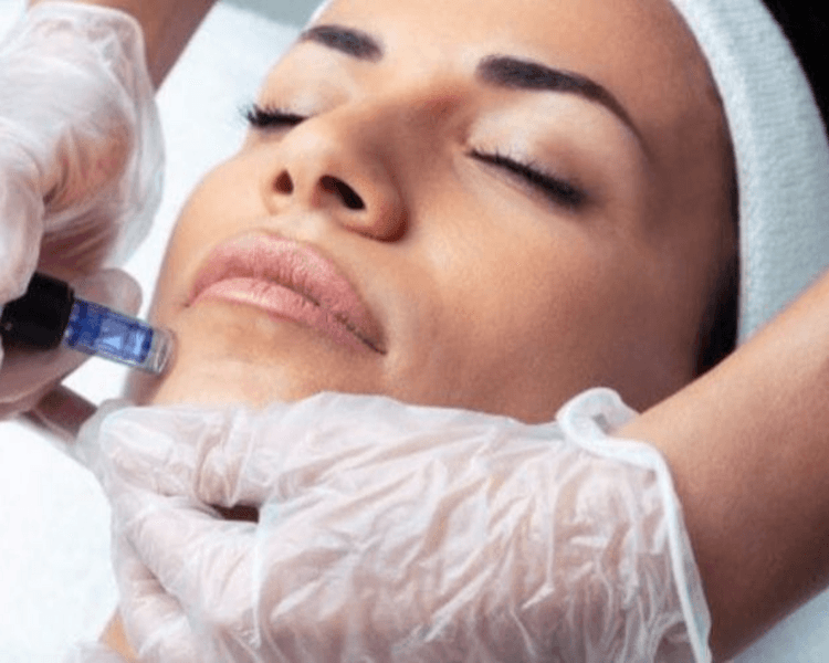 Microneedling (Induccion al Colageno con Dermapen)