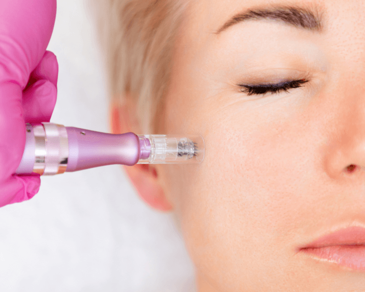 Microneedling con activos nacionales