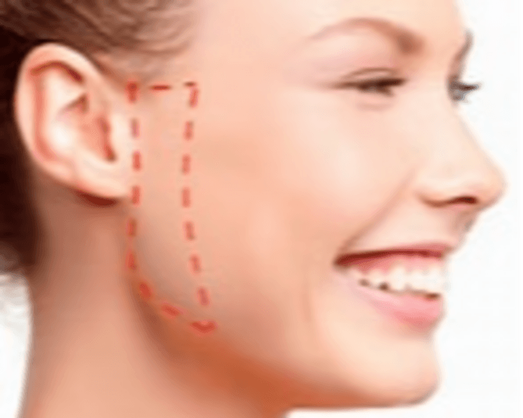 Zona a elegir: Frente, patilla, mentón, bozo, orejas o dedos ya sea de pies o de manos.