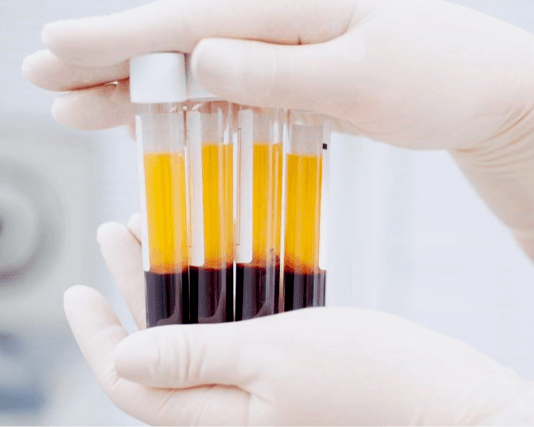 Plasma rico en plaquetas capilar