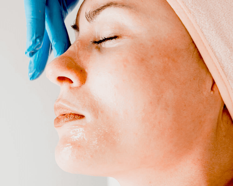 Tratamiento de Acne Pre y Post 3 Sesiones Técnica: Hydrapen H5, hollywood peel y protocolo químico