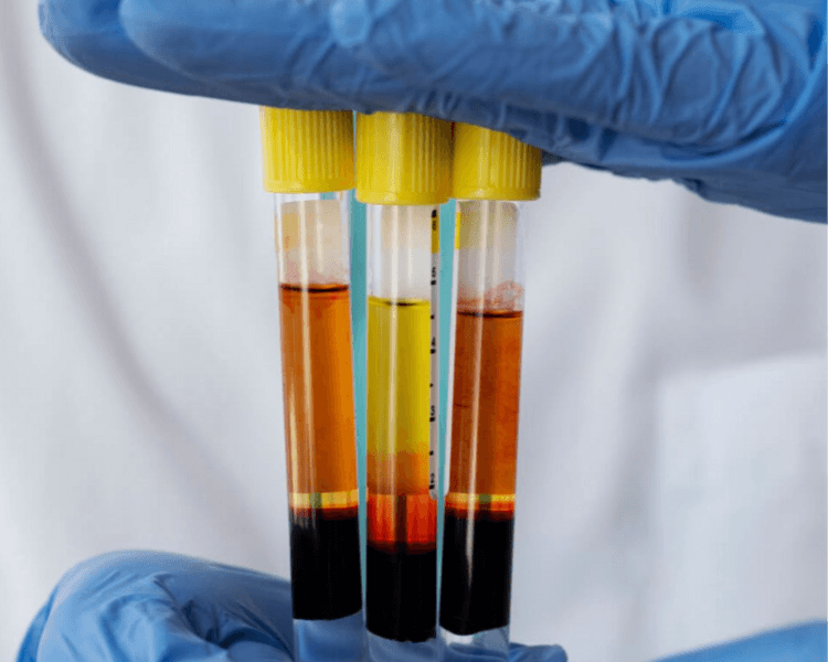 Plasma rico en plaquetas