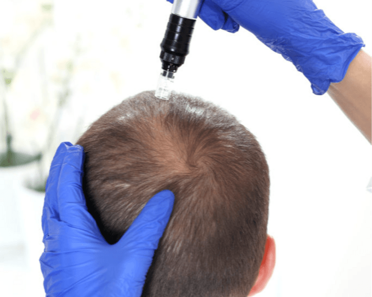 Plasma Capilar (Rico en plaquetas)