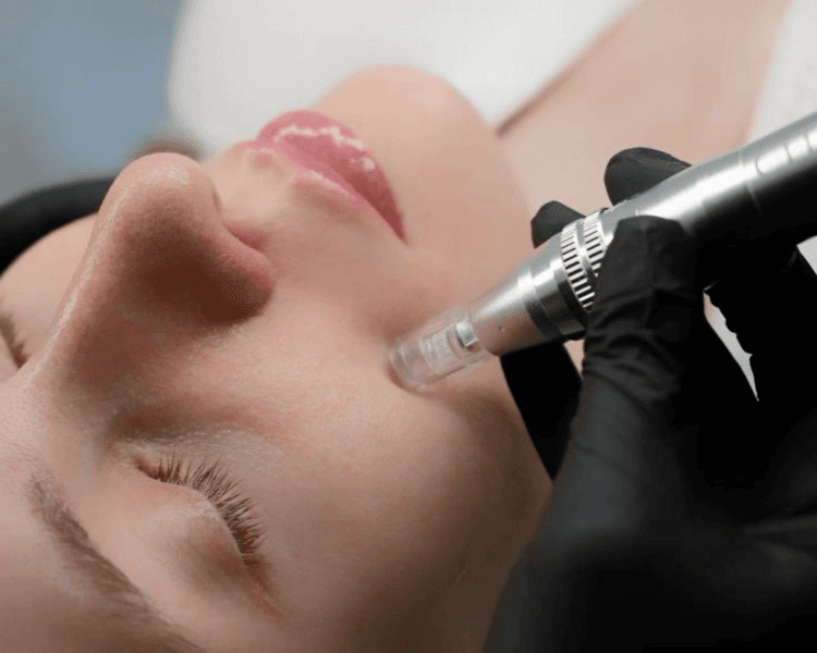 LIMPIEZA PROFUNDA + DERMAPEN CON EXOSOMAS