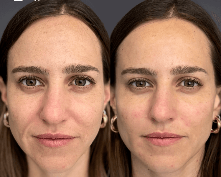 Long Lasting - Bioestimulador