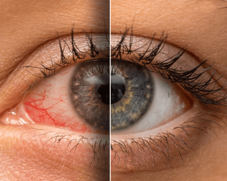 Stellar M22 IPL - Ojo Seco